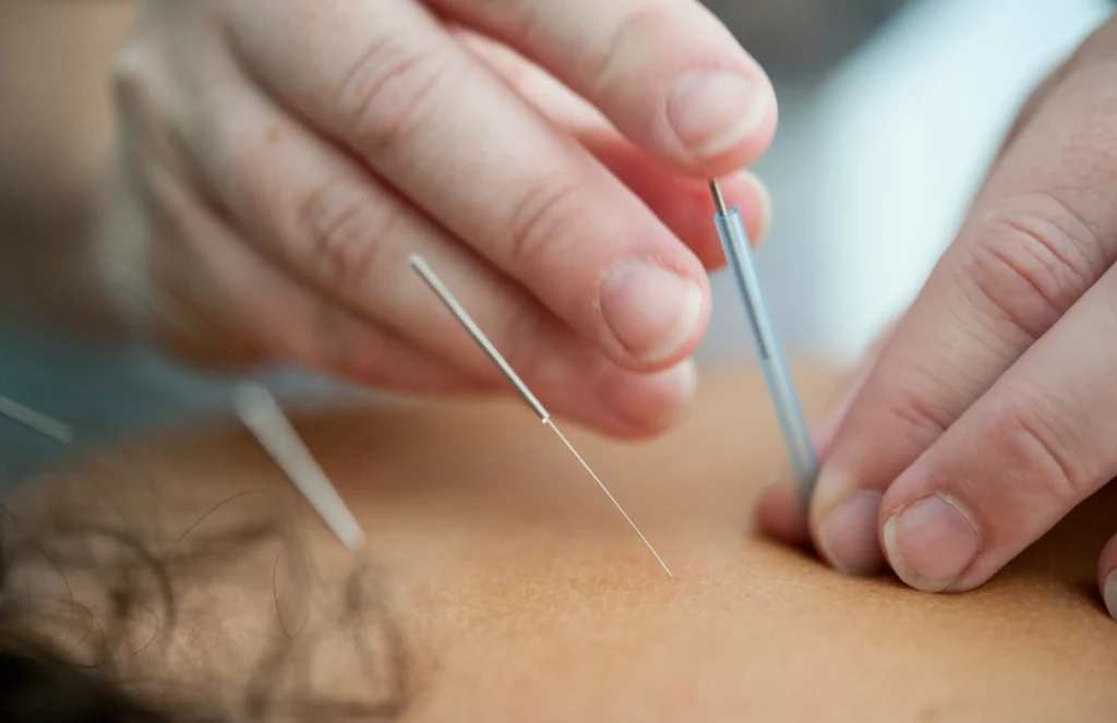 Acupuncture clinic in West Vancouver offering professional acupuncture treatment in a calm and relaxing medical spa environment