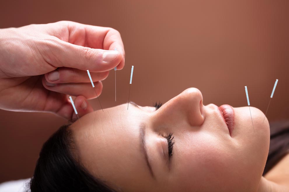 Acupuncture Acupuncture needles placed on a client’s face